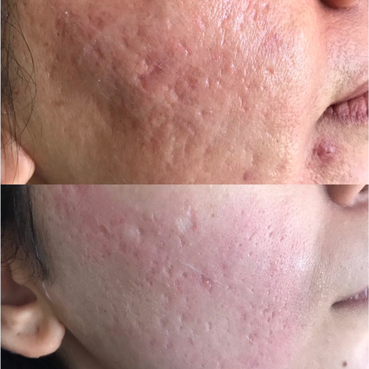 acne-acne scar (2)