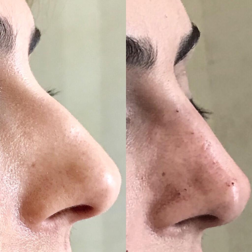 nose (5)